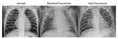 CNN model in PyTorch for generating chest X-ray images, utilizing convolutional layers, reparameterization, and performance evaluation with FID and Inception Score.